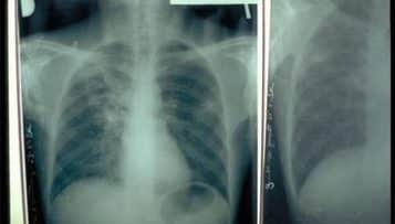 Conduite à tenir par le médecin du travail face à une tuberculose pulmonaire